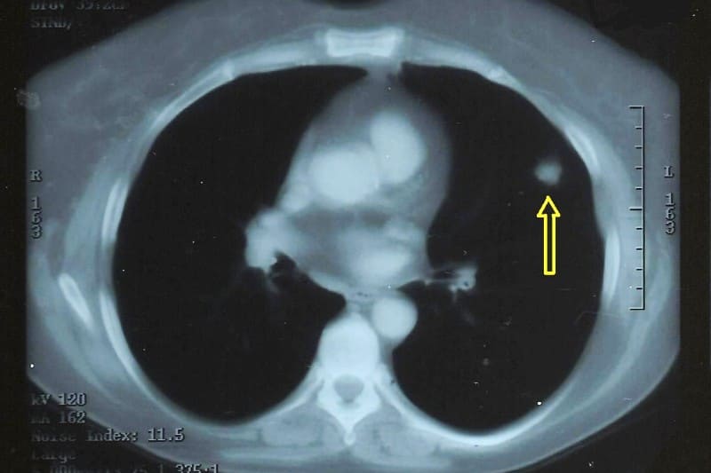 폐에 결절이 있는 MRI 검사 결과