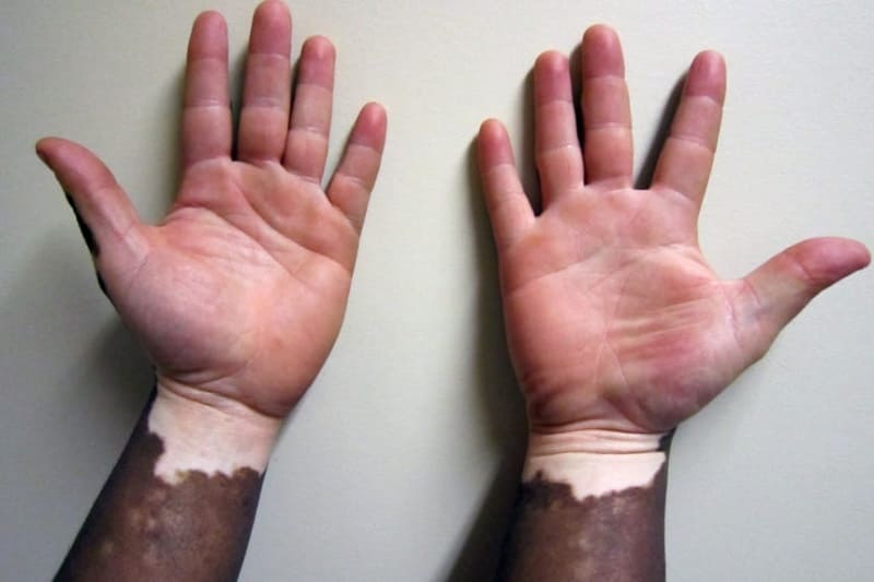 백반증 있는 사람의 손
